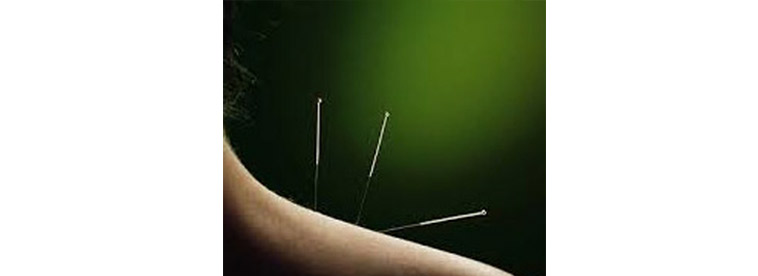 Acupuncture Needles